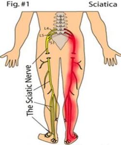 چارەسەری ژانی (دەماری سمت و ڕان) لە سوننەت دا به‌شى دووه‌م